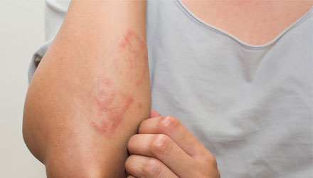allergias-kiutes-ellen-redpower-allergy