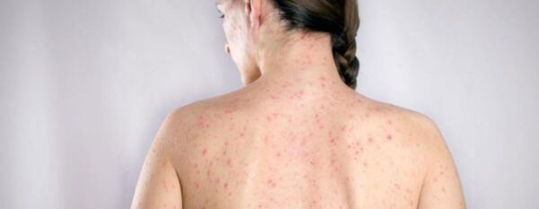 baranyhimlo-ellen-redpower-allergy baranyhimlo-ellen-redpower-allergy